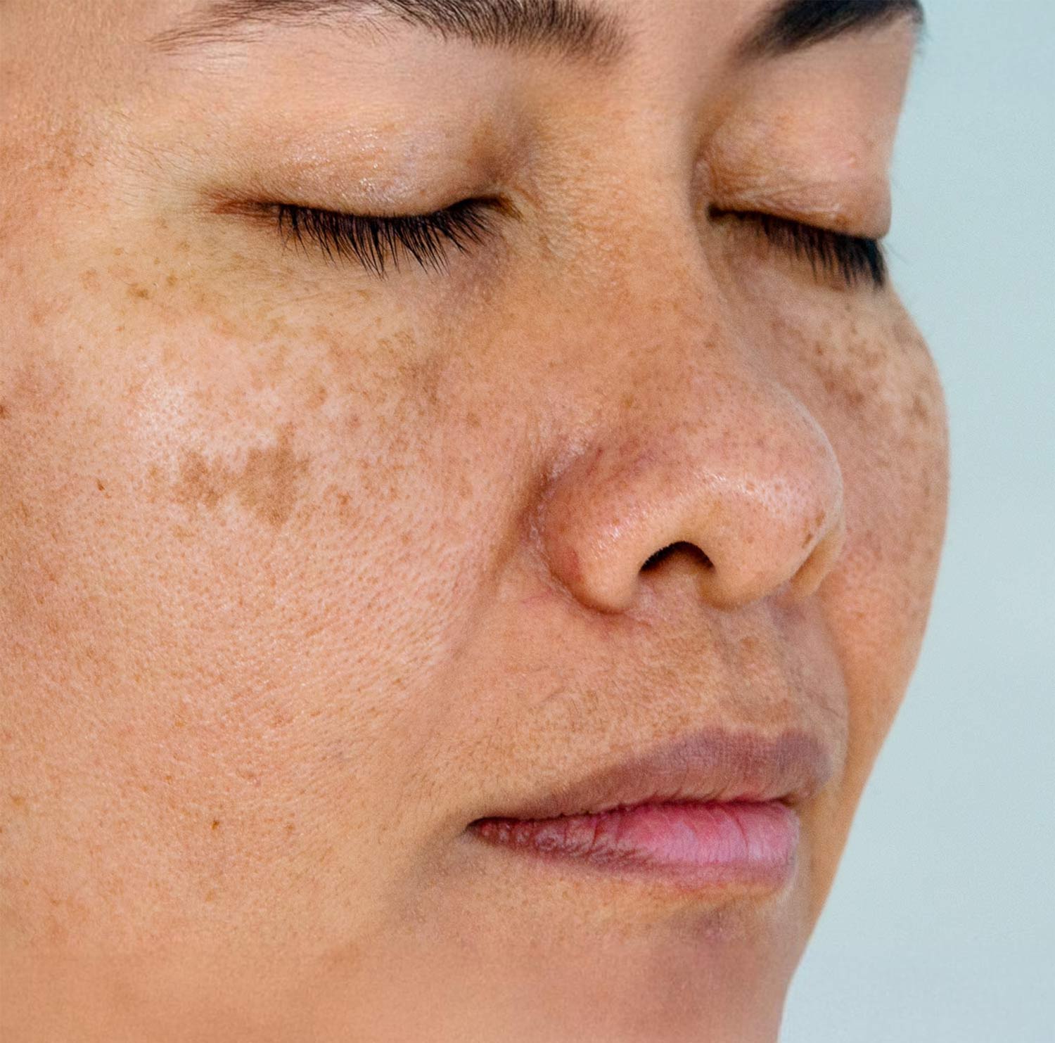 Hyper- Pigmentation