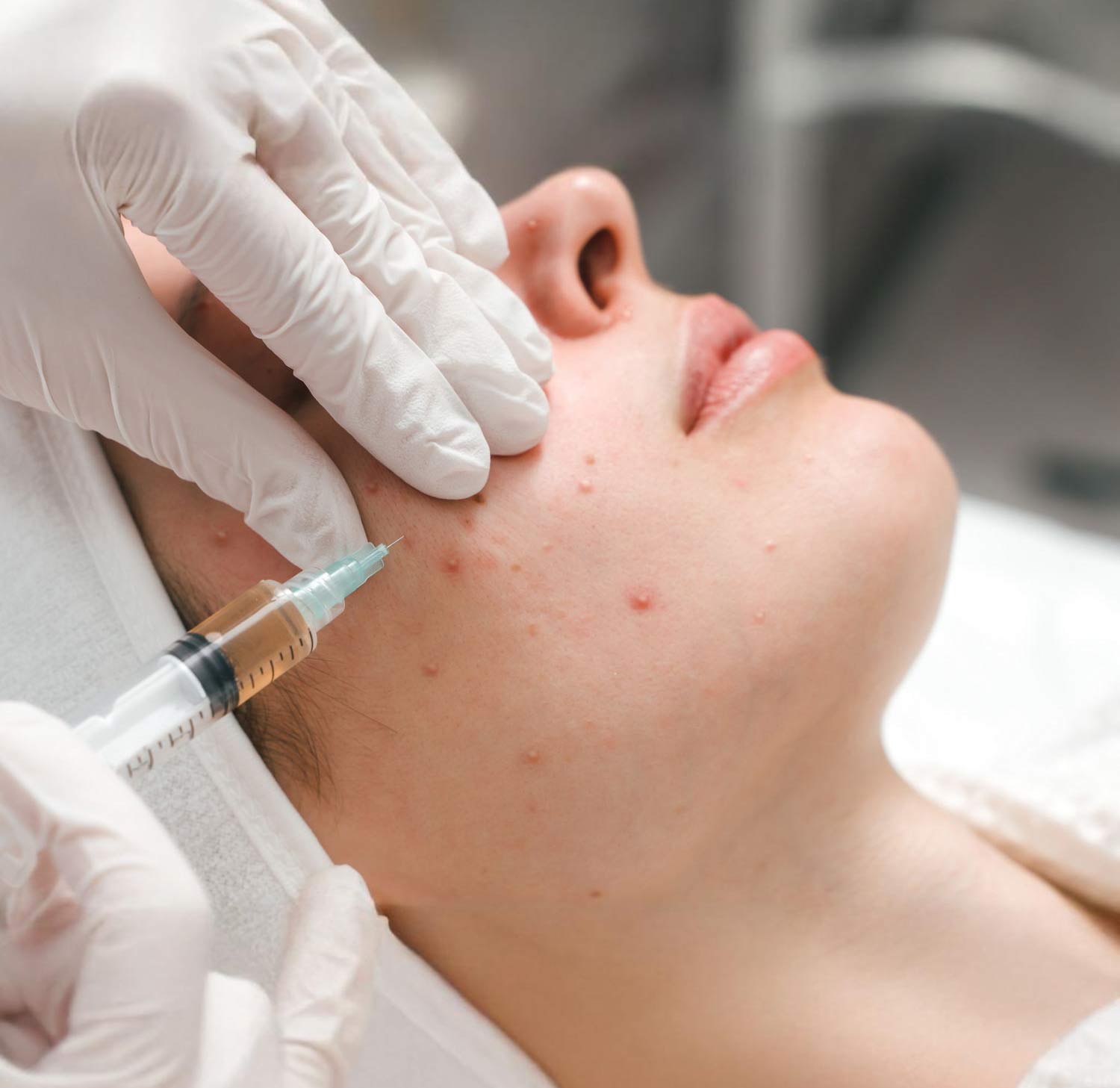 Acne Scars