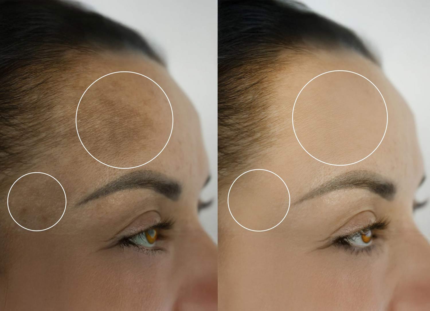 Melasma